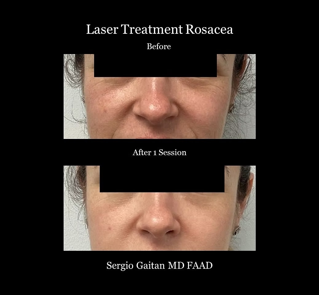 Rosacea Laser Treatment Before & After