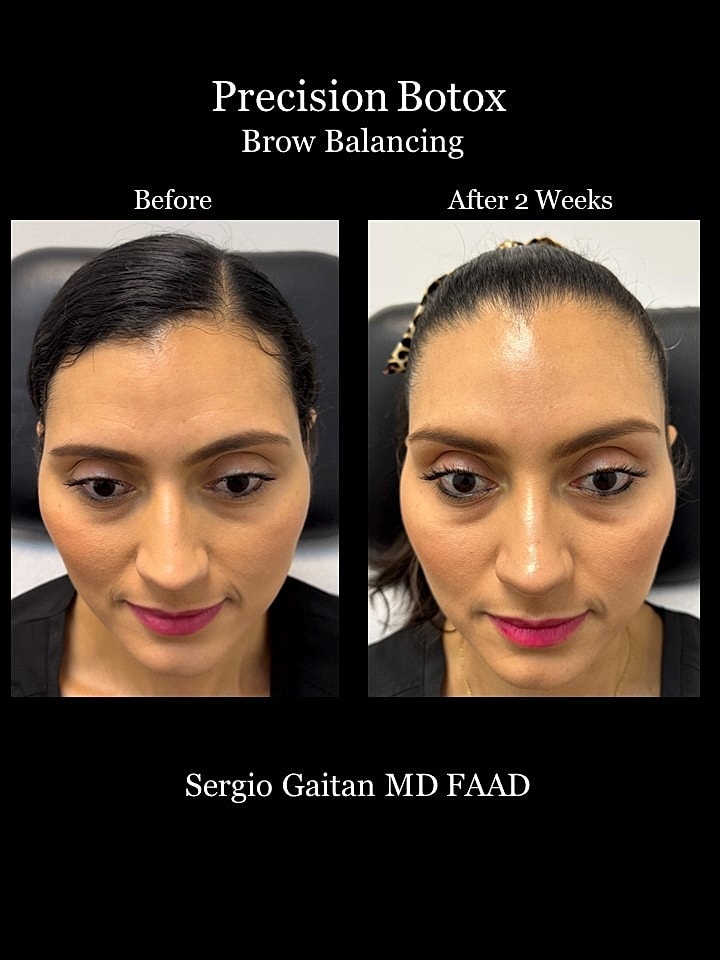 Botox Before & After