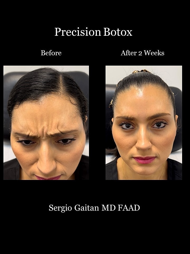 Botox Before & After