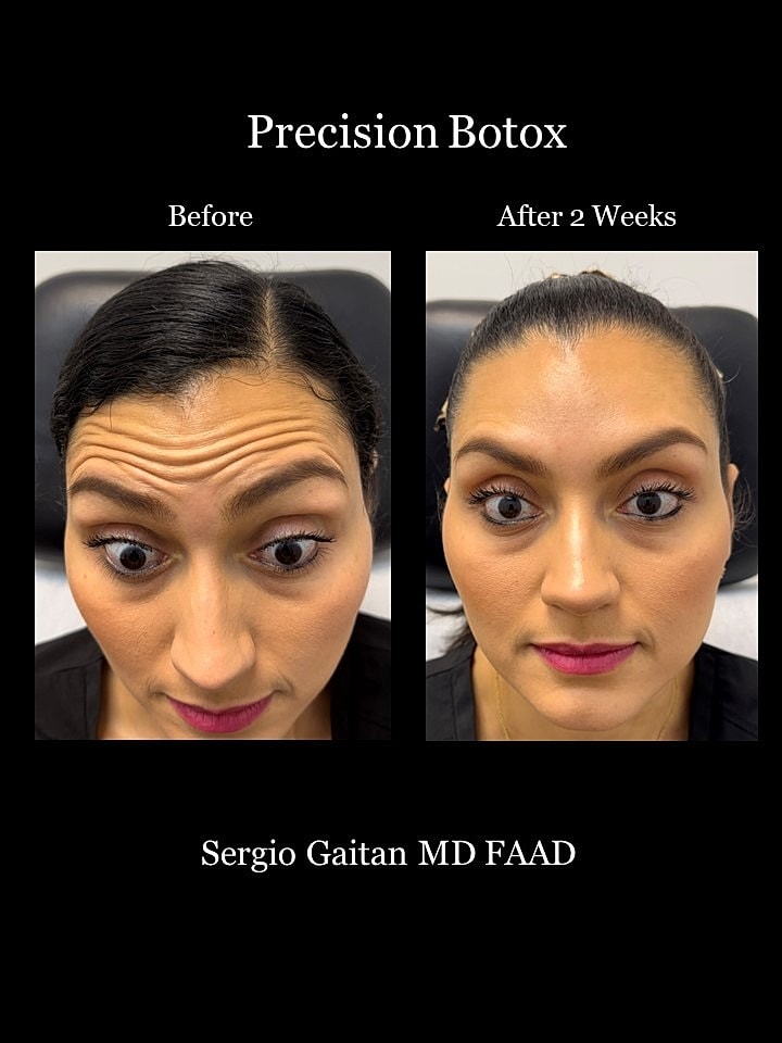 Botox Before & After