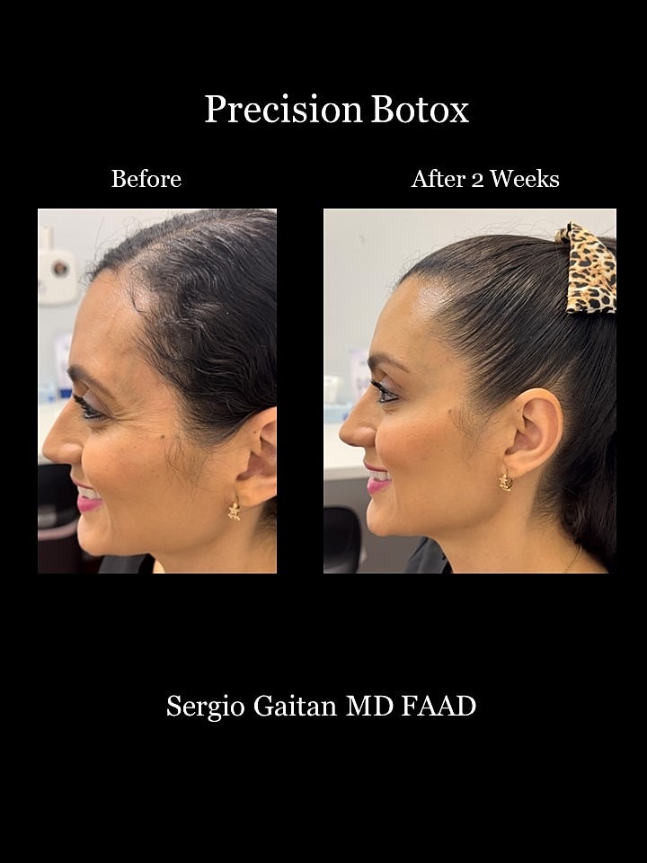 Botox Before & After