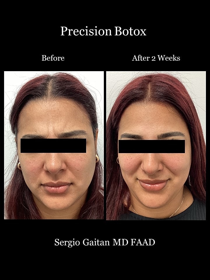 Botox Before & After