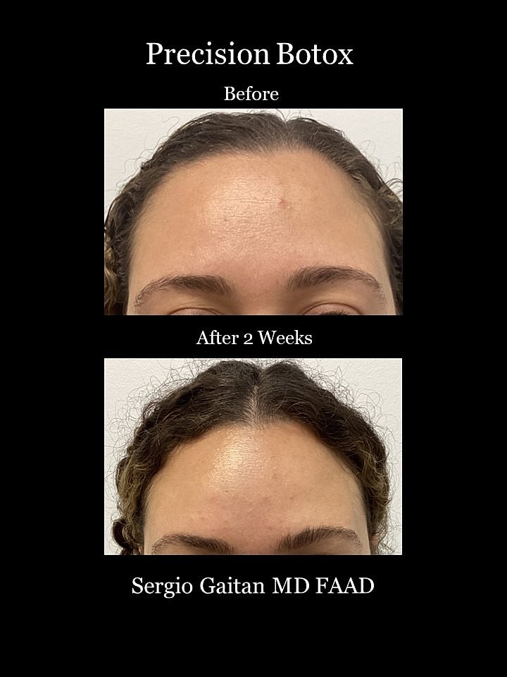 Botox Before & After
