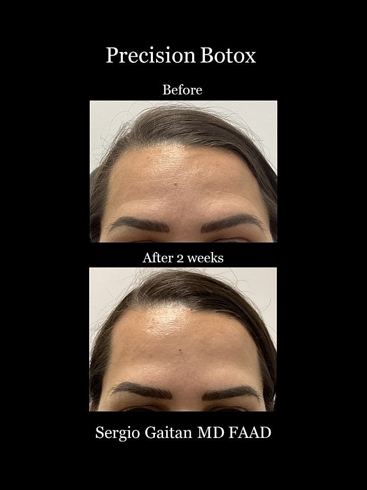 Botox Before & After