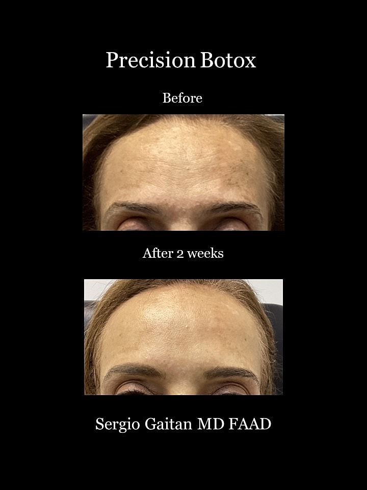 Botox Before & After