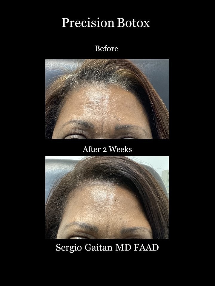 Botox Before & After