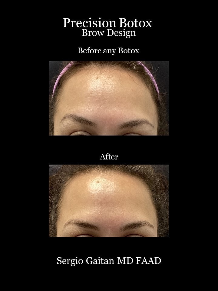 Botox Before & After