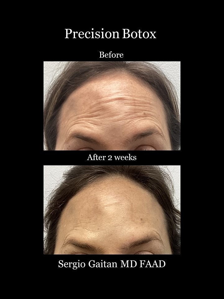 Botox Before & After