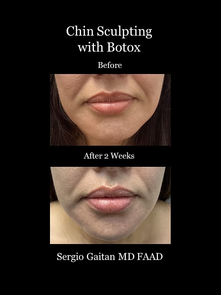 Botox Before & After