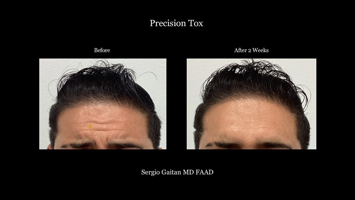 Botox Before & After