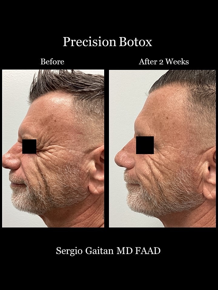 Botox Before & After