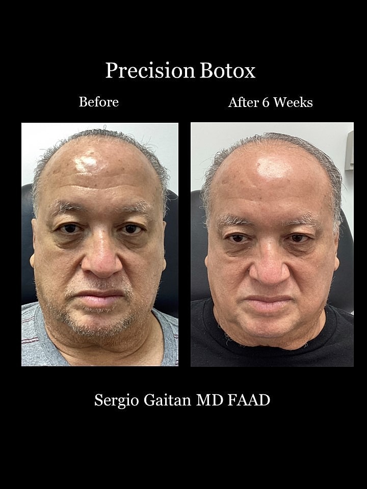 Botox Before & After