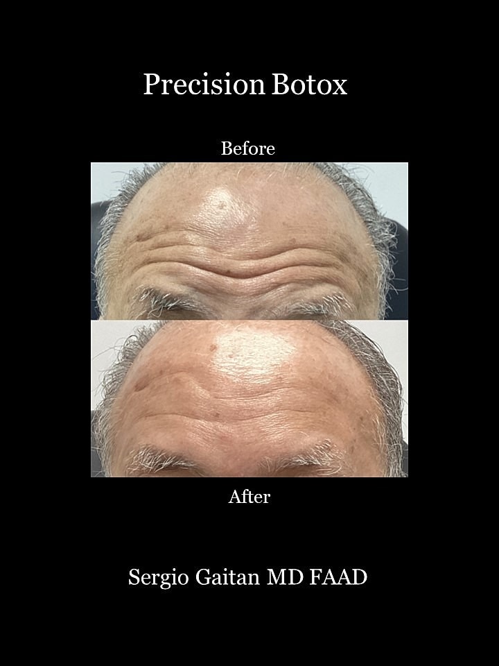 Botox Before & After