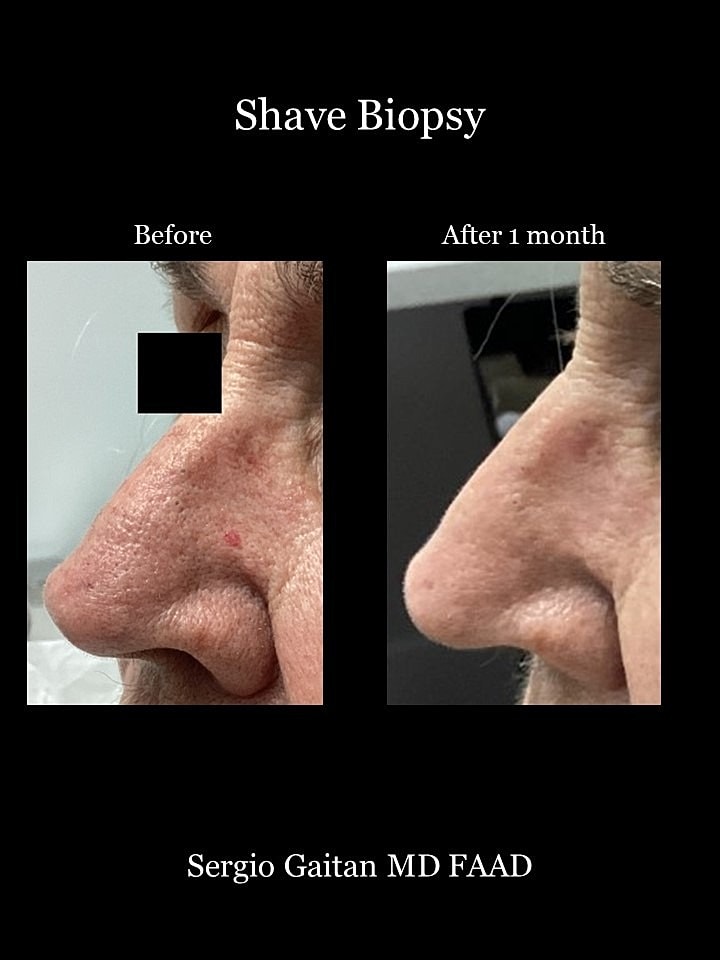 Shave Biopsy Before & After