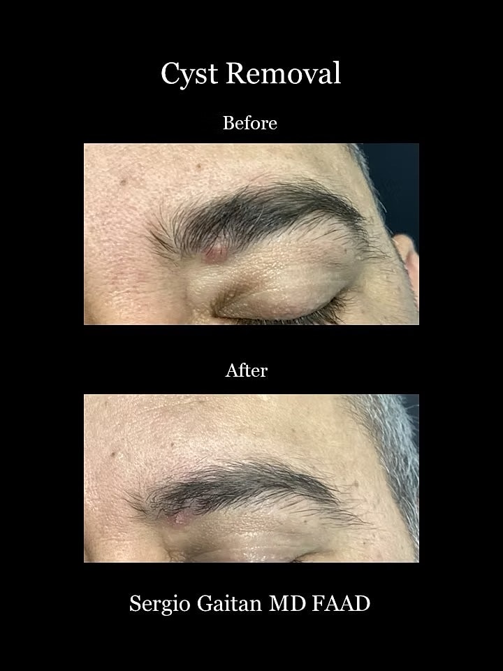 Cyst Removal  Before & After