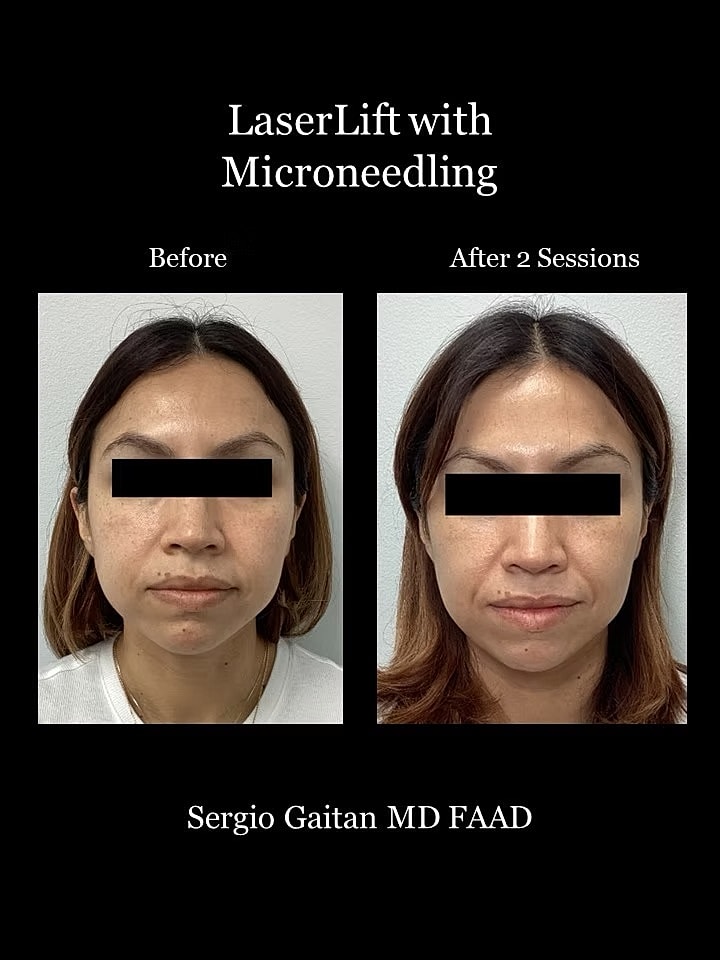 Laser Microneedling Before and After in Miami, Fl Before & After