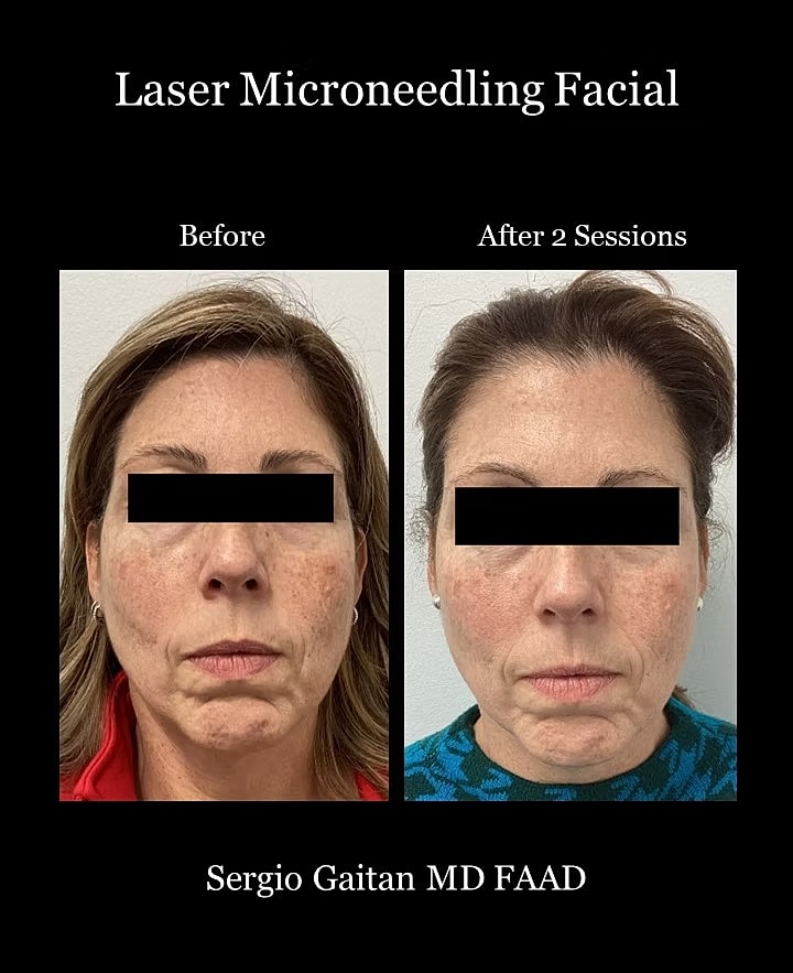 Laser Microneedling Before and After in Miami, Fl Before & After