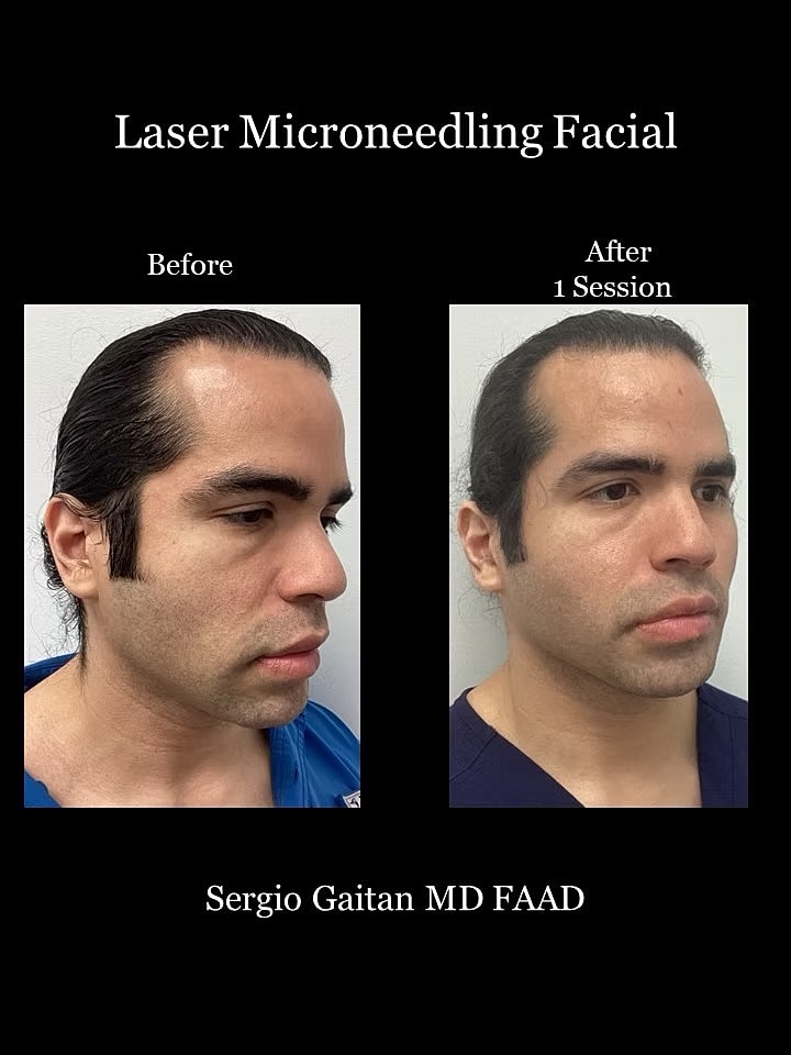 Laser Microneedling Before and After in Miami, Fl Before & After