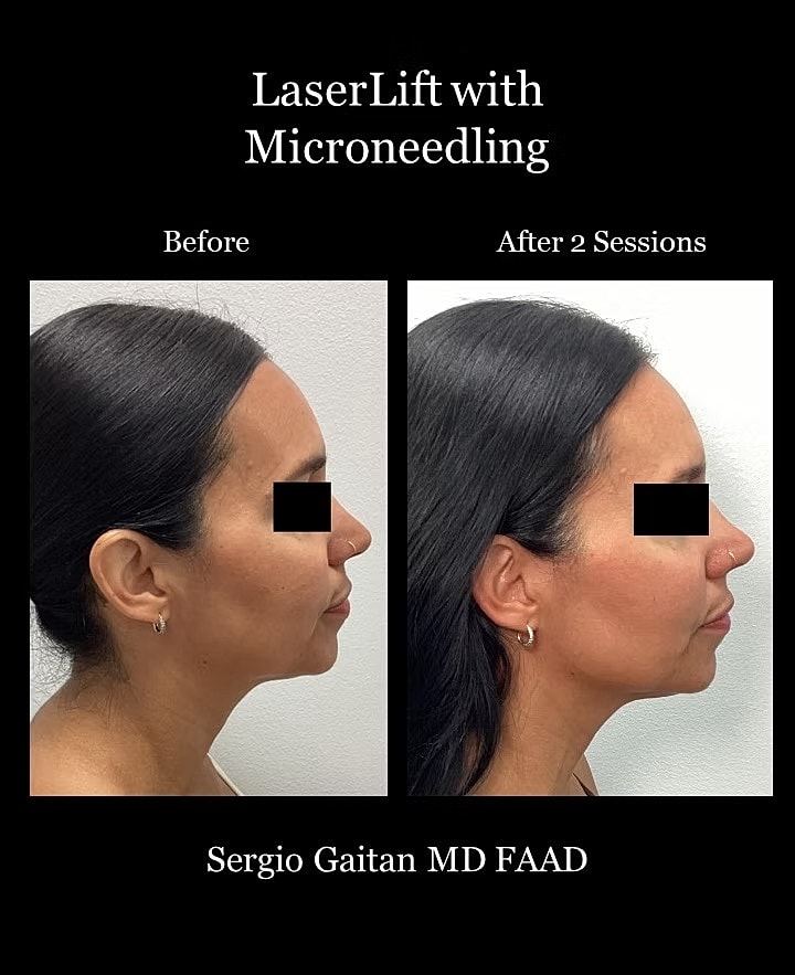 Laser Microneedling Before and After in Miami, Fl Before & After