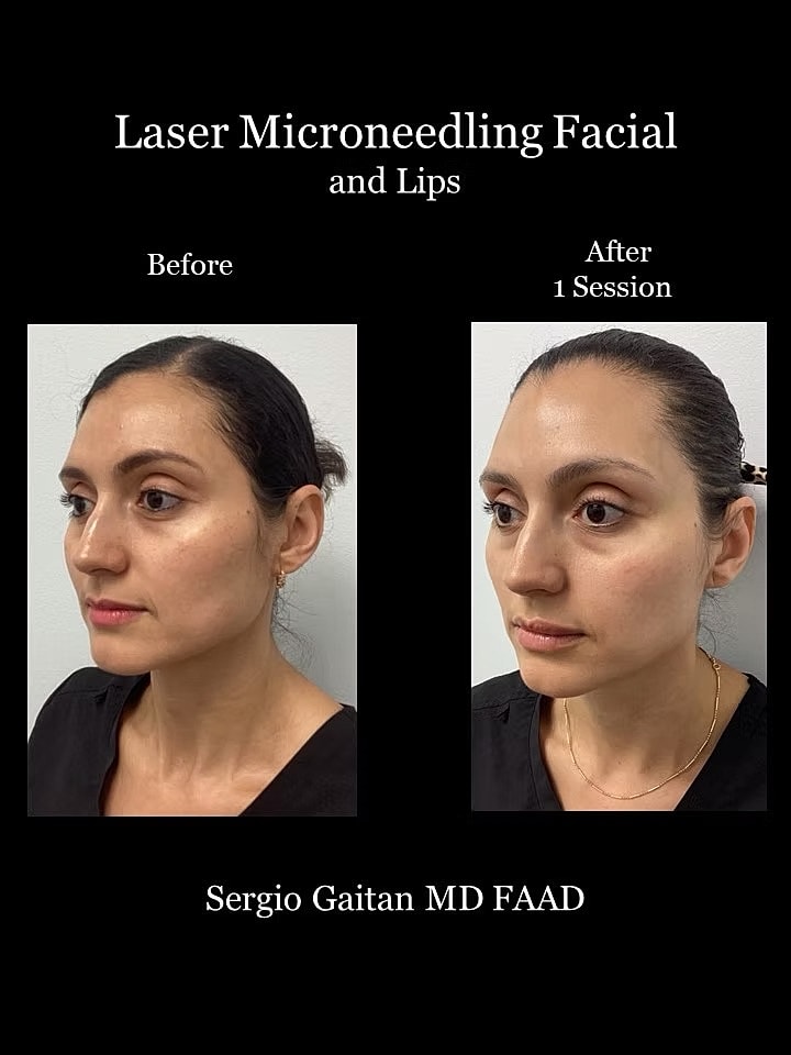Laser Microneedling Before and After in Miami, Fl Before & After