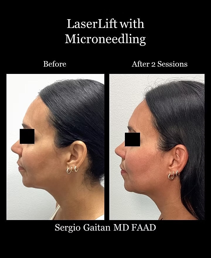 Laser Microneedling Before and After in Miami, Fl Before & After