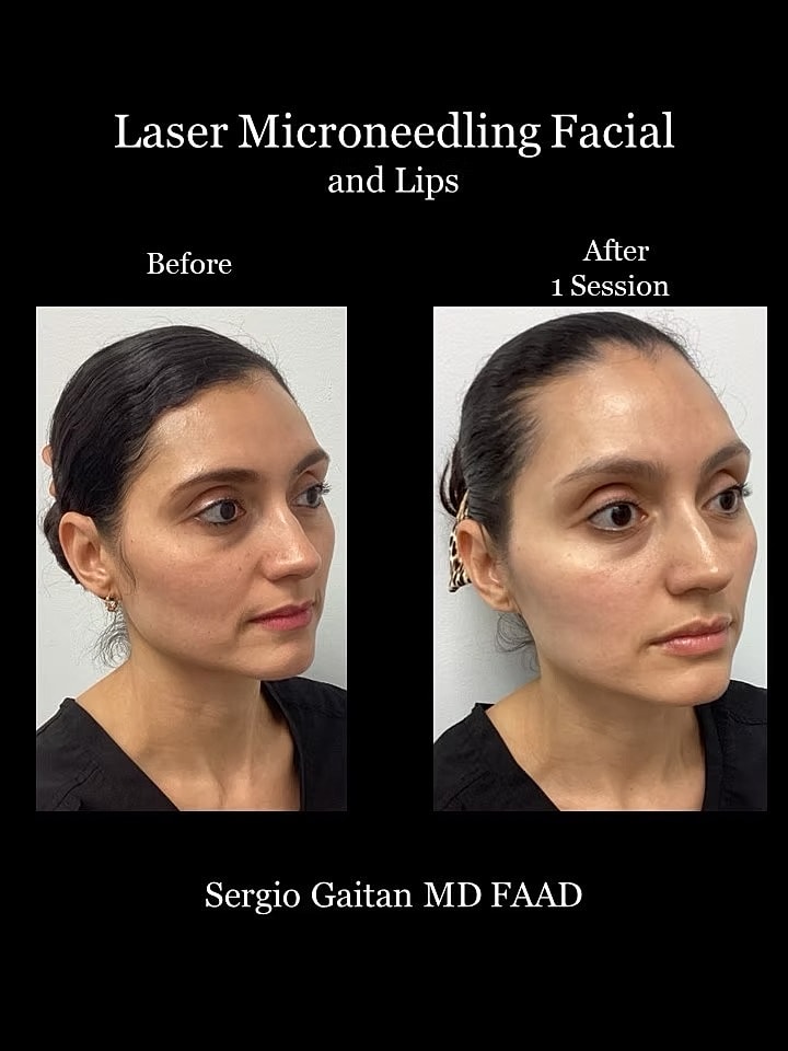 Laser Microneedling Before and After in Miami, Fl Before & After