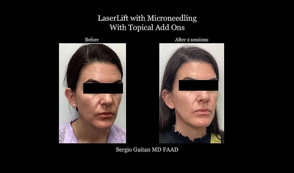 Before & After