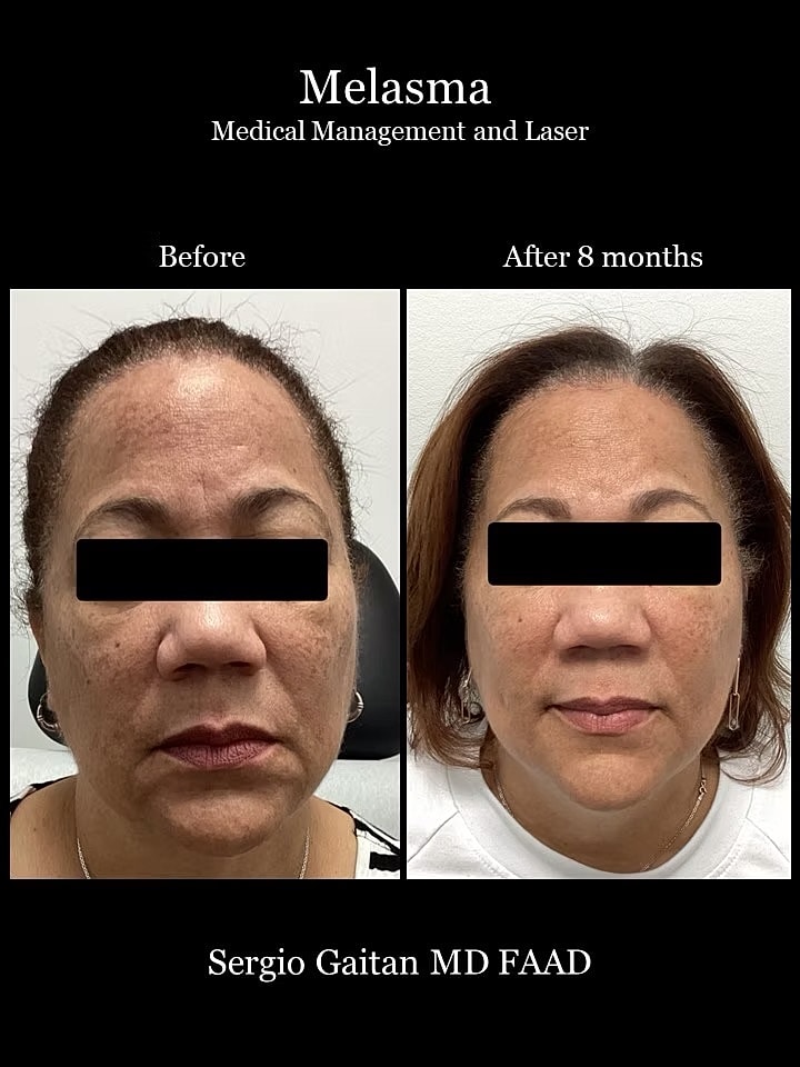 Melasma Before & After