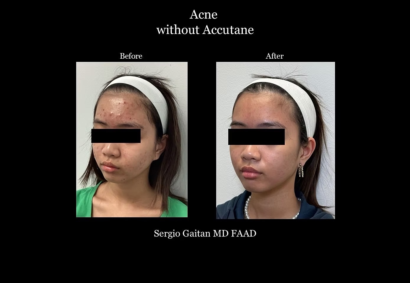 Acne Before & After