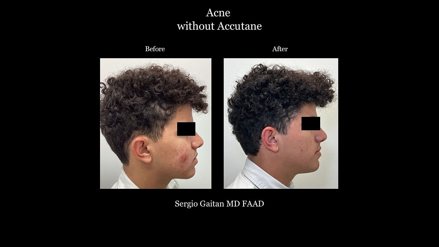 Acne Before & After