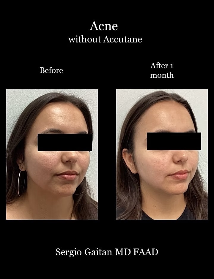 Acne Before & After