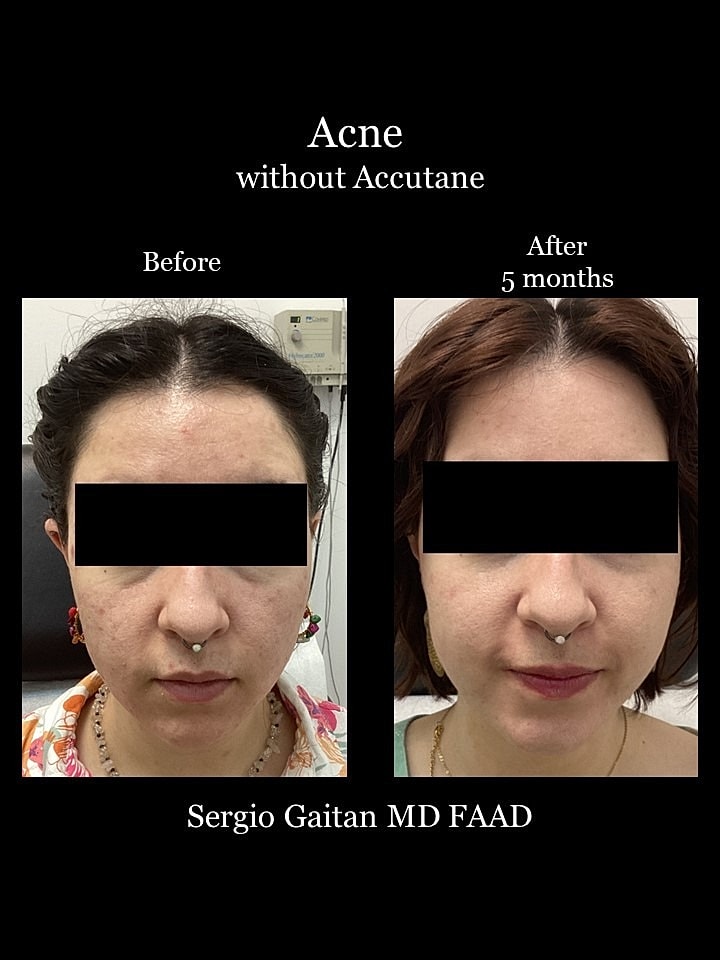 Acne Before & After