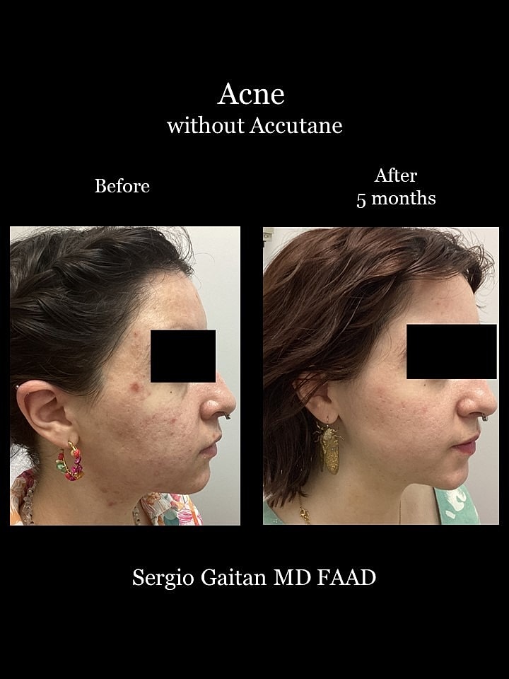 Acne Before & After