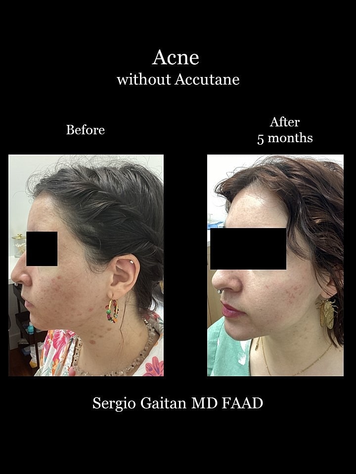 Acne Before & After