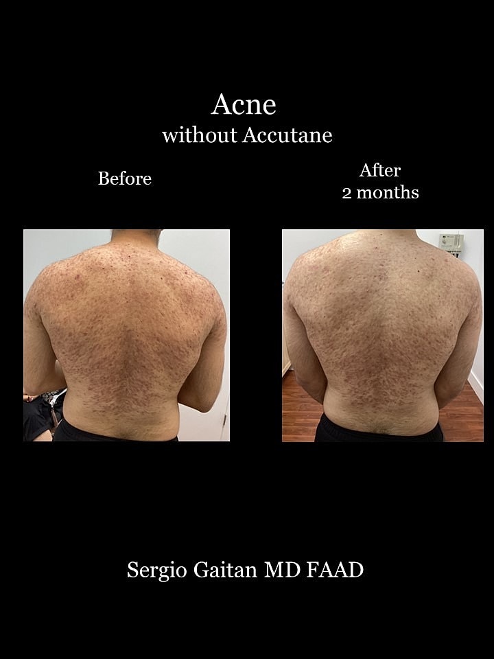 Acne Before & After