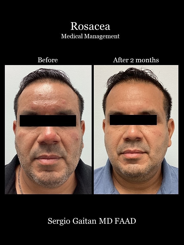 Rosacea Before & After