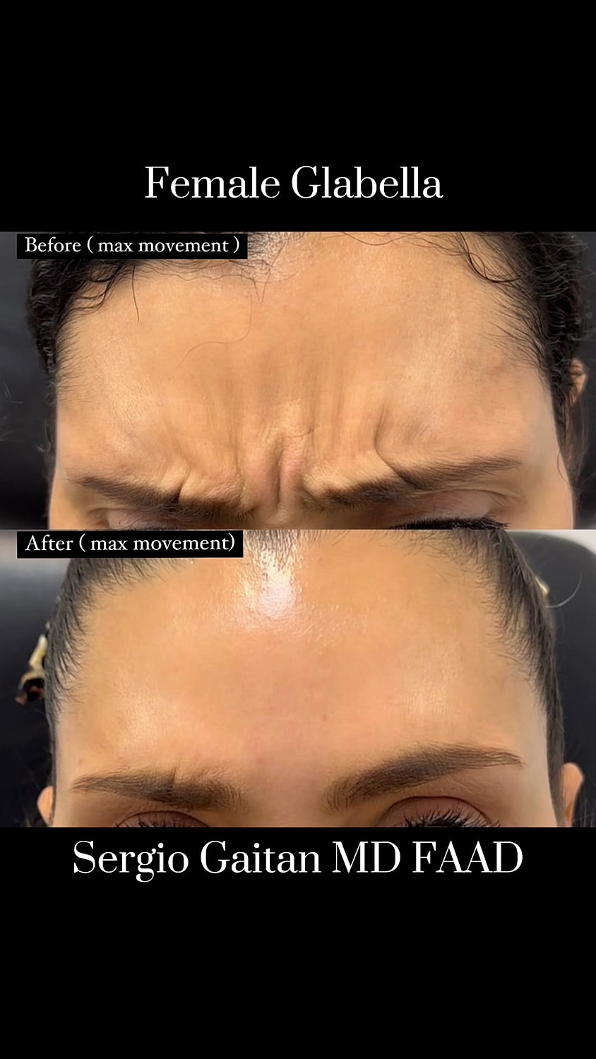 Before and after glabella treatment comparison.