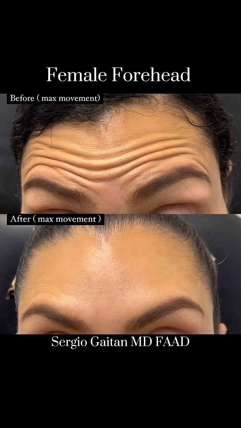 Forehead wrinkle reduction before and after treatment